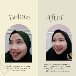 mengobati flek hitam di wajah