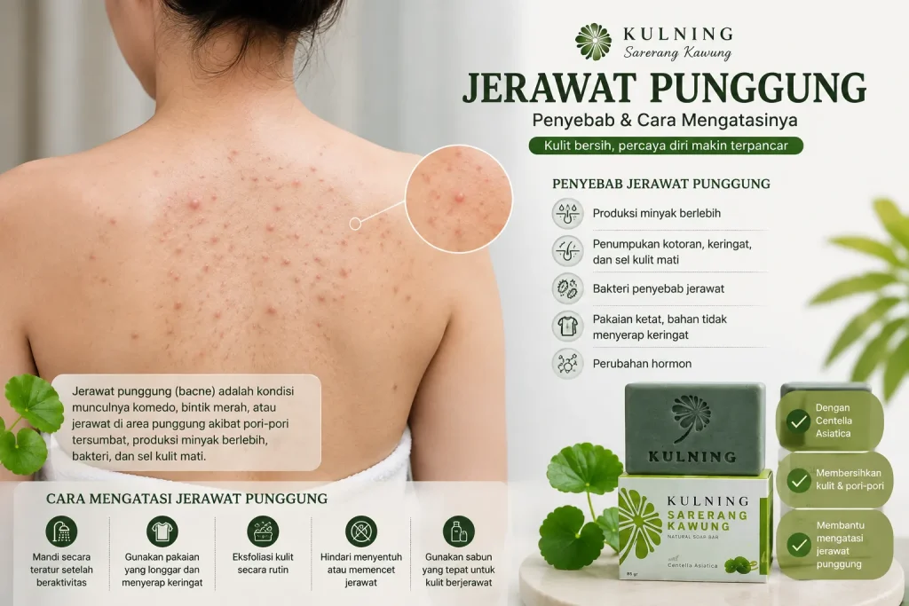 Jerawat punggung dan cara mengatasi jerawat punggung
