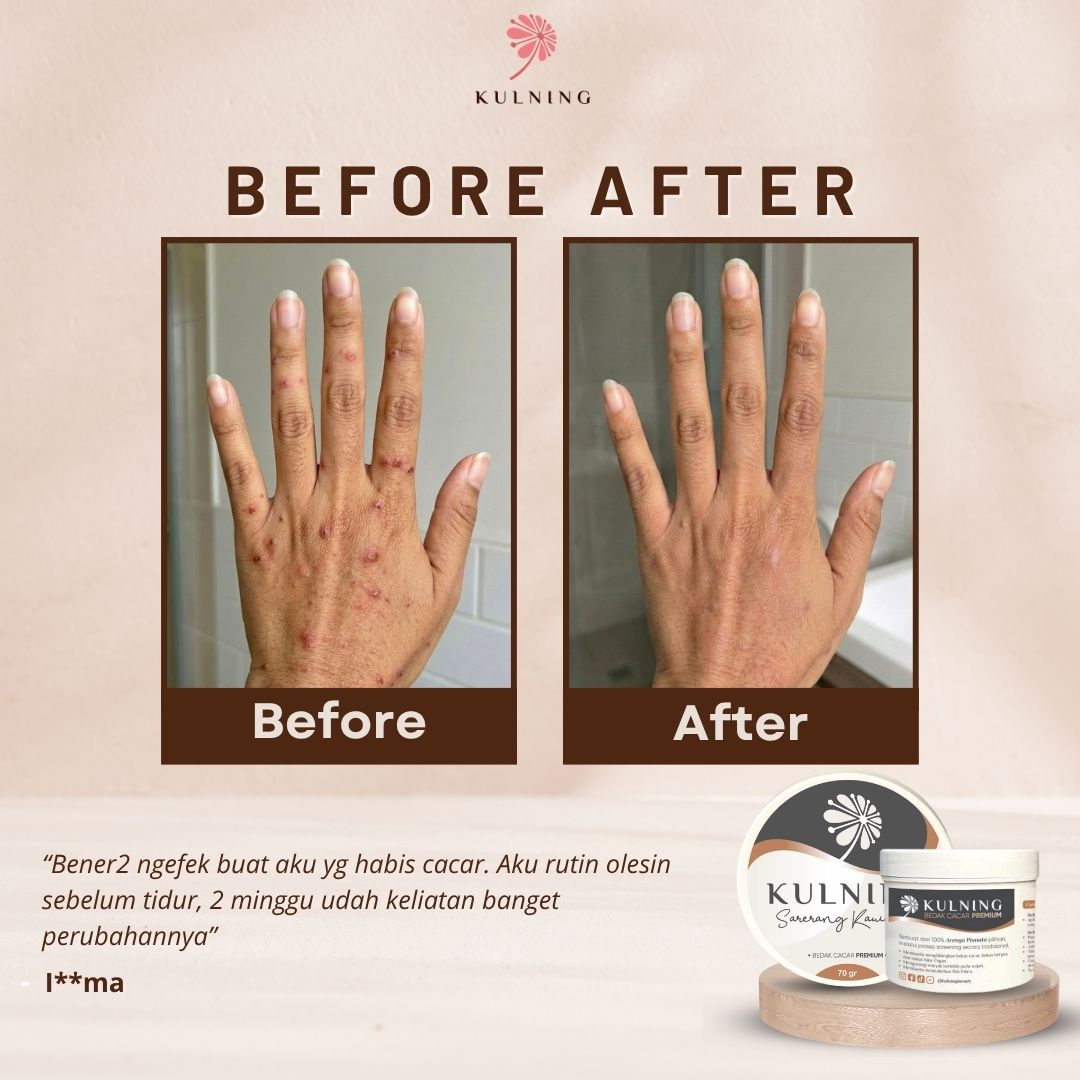 Bedak Cacar Premium - Gambar 2